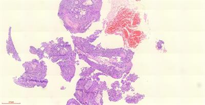 Diagnosis of contralateral rare pulmonary cavity metastasis after lung squamous cell carcinoma surgery by electromagnetic navigation: one case report and review of the literature